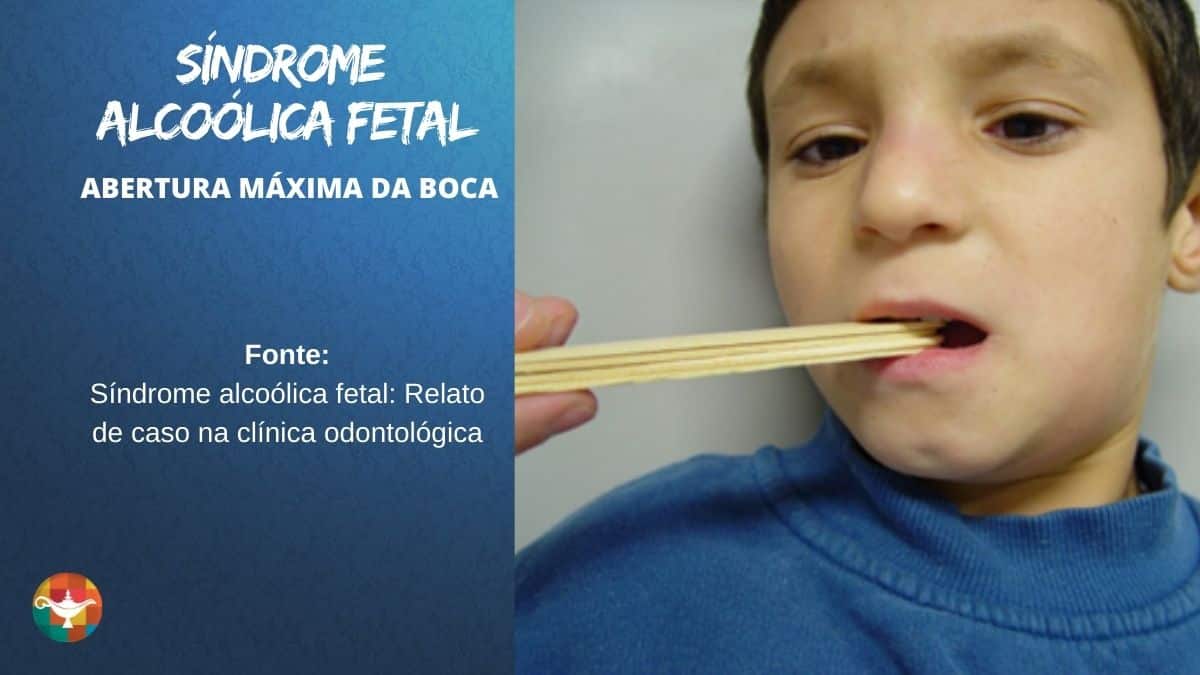 Síndrome Alcoólica Fetal Sou Enfermagem