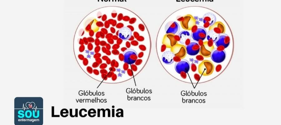 A Leucemia Pode se Espalhar para outros Órgãos?