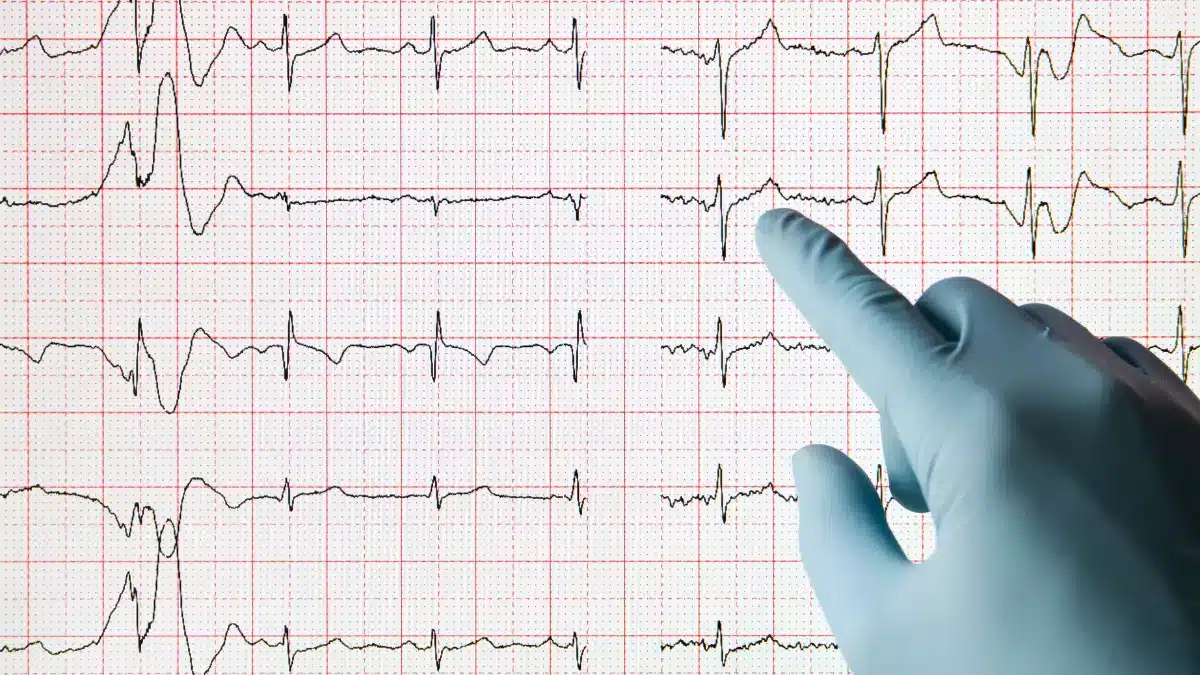 Caracterização Das Alterações Eletrocardiográficas Em Situações ...